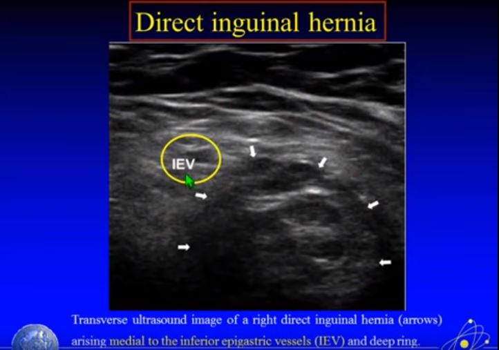 Direct And Indirect Hernia Inguinal Hernia Ahn Indirect Inguinal