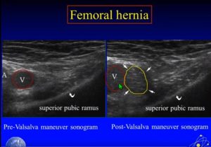 The femoral hernia lies medial to the femoral vein and below the ...