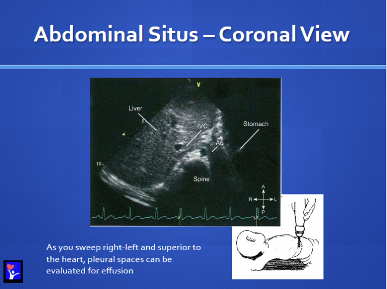IVC to Right Atrium 19