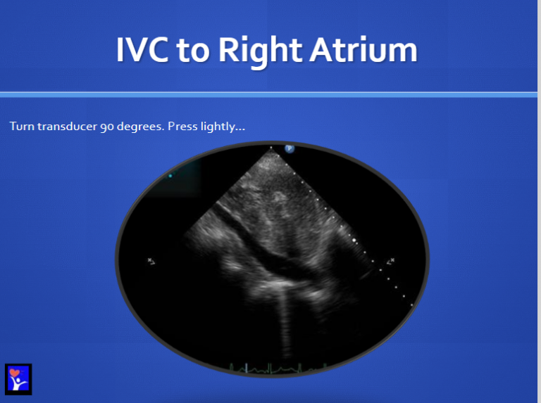 Subcostal Frontal Sweep 2022
