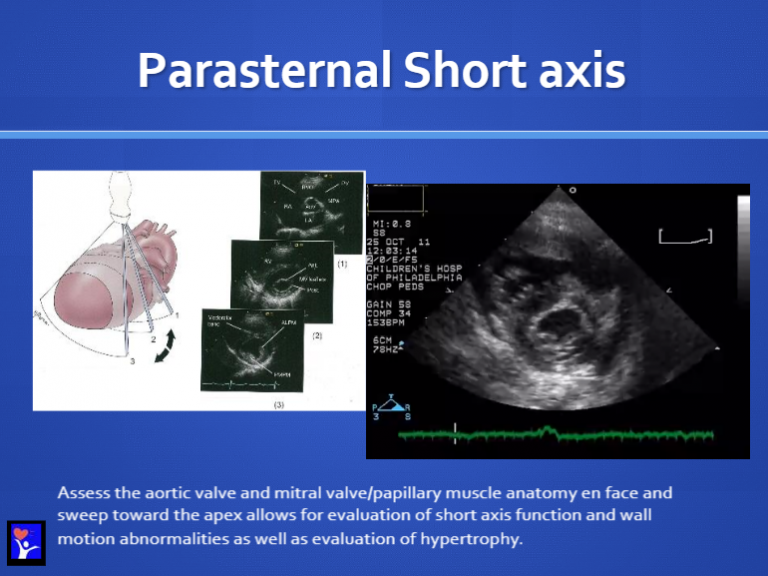 Parasternal Short Axis Fanning from Basics of Functional echocardiography in Children and