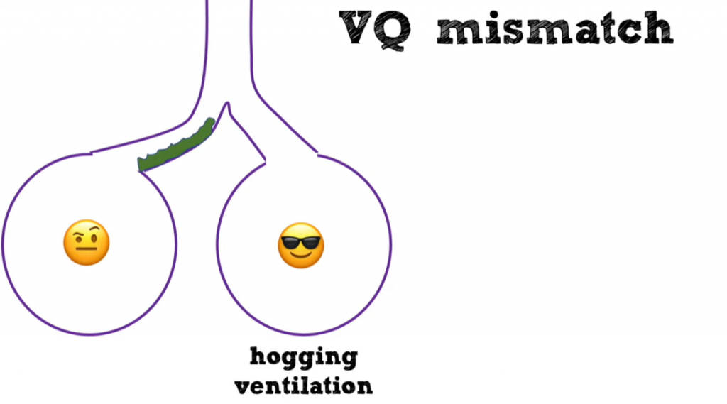 The next section of the transcript discusses V/Q mismatch.