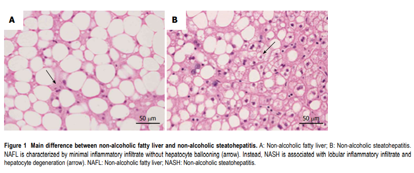 fatty liver histology